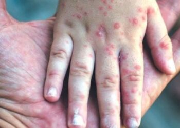 गोवर उद्रेकामुळे चिंता वाढली